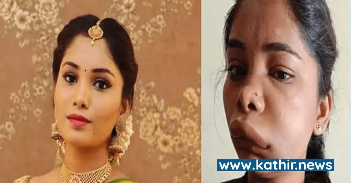 மயக்க மருந்துக்கு பதிலாக ஆசிட் - நடிகைக்கு விகாரமான முகம் மாறியது எப்படி?