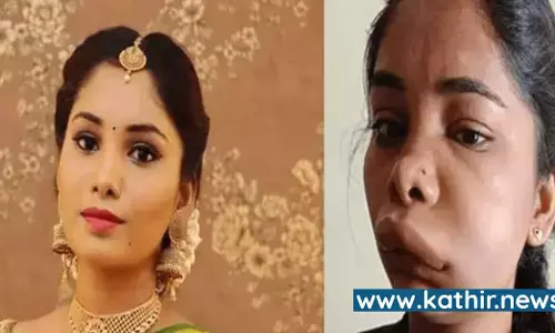 மயக்க மருந்துக்கு பதிலாக ஆசிட் - நடிகைக்கு விகாரமான முகம் மாறியது எப்படி? மயக்க மருந்துக்கு பதிலாக ஆசிட் - நடிகைக்கு விகாரமான முகம் மாறியது எப்படி?