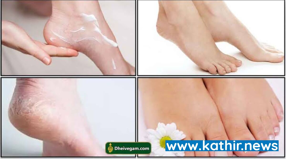 குதிகால் வெடிப்பும் அதை தடுக்கும் மருத்துவ முறைகளும்