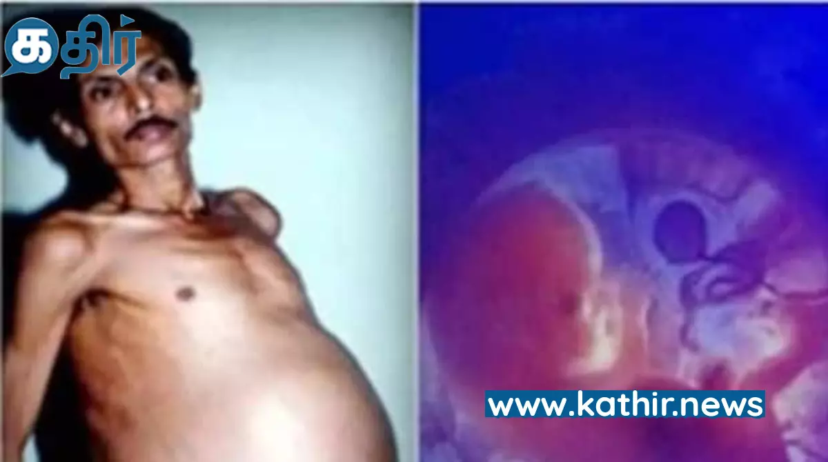 இயற்கையின் விந்தையில் இப்படி கூட நடக்குமா? 36 ஆண்டுகளாக இரட்டை குழந்தைகளை வயிற்றில் சுமந்த ஆண்! இயற்கையின் விந்தையில் இப்படி கூட நடக்குமா? 36 ஆண்டுகளாக இரட்டை குழந்தைகளை வயிற்றில் சுமந்த ஆண்!